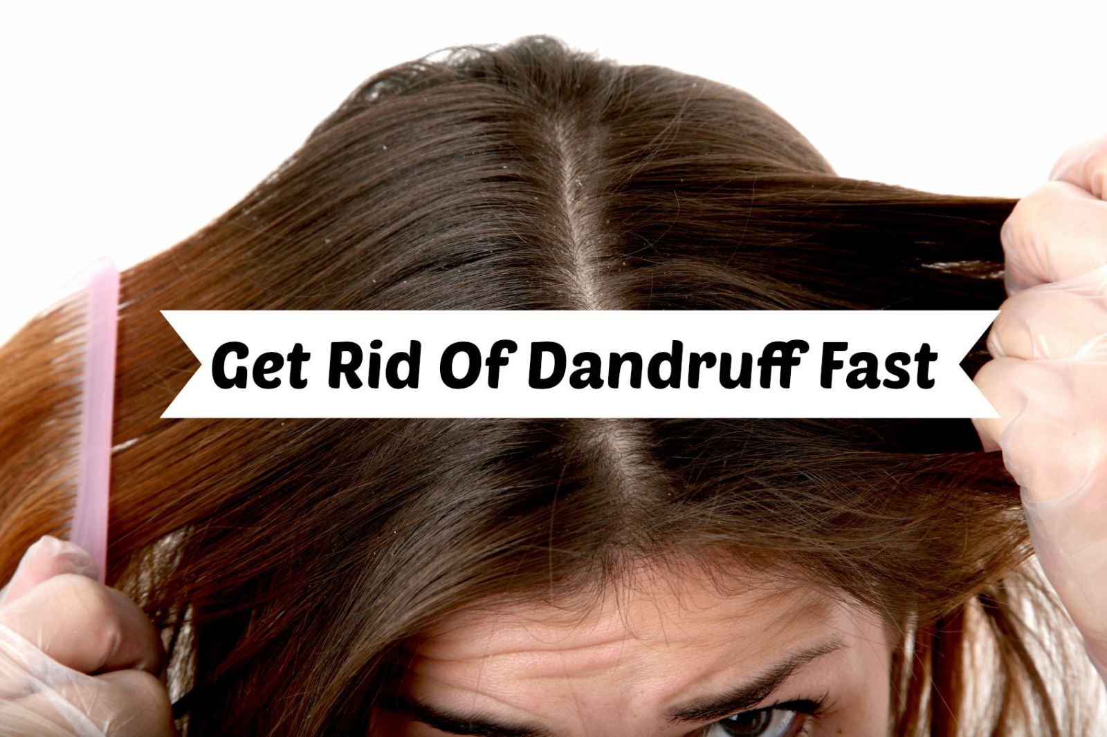 Home Remedies To Get Rid Of Dandruff By Dr. Bilquis